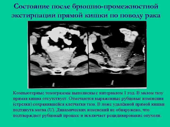 Состояние после брюшно-промежностной экстирпации прямой кишки по поводу рака Компьютерные томограммы выполнены с интервалом