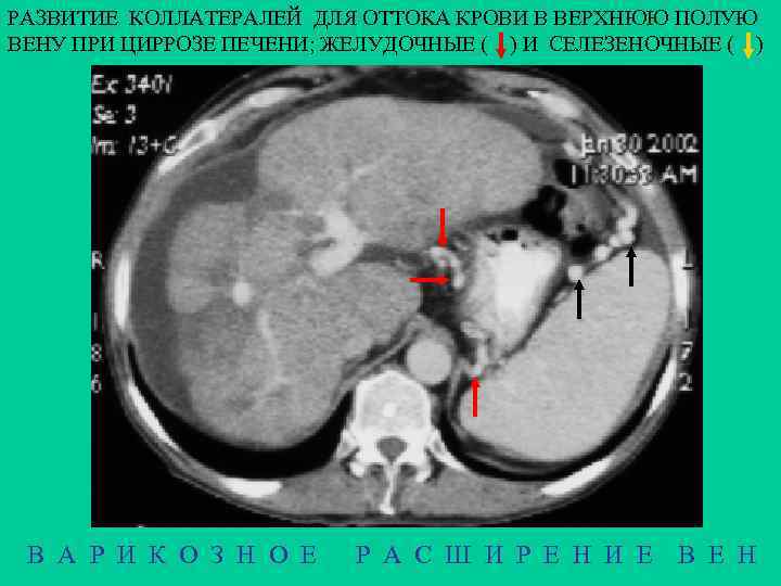 РАЗВИТИЕ КОЛЛАТЕРАЛЕЙ ДЛЯ ОТТОКА КРОВИ В ВЕРХНЮЮ ПОЛУЮ ВЕНУ ПРИ ЦИРРОЗЕ ПЕЧЕНИ; ЖЕЛУДОЧНЫЕ (
