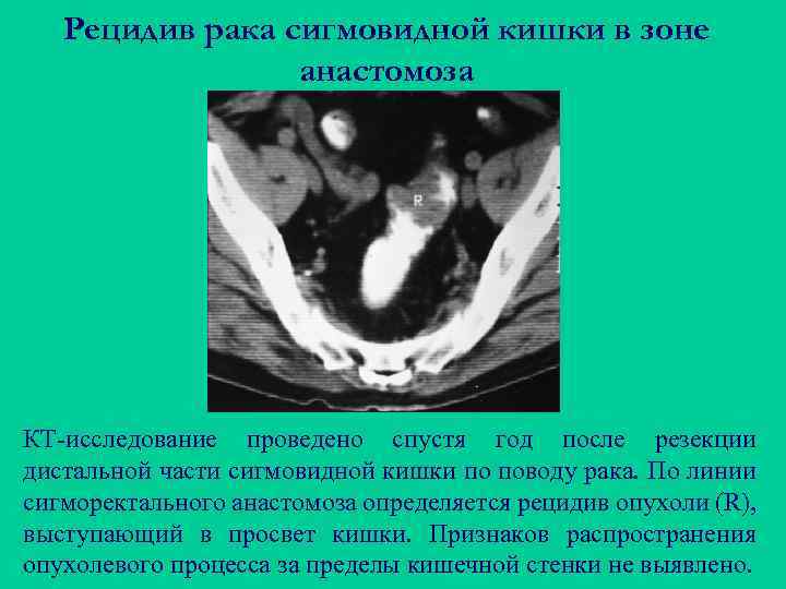 Где находится сигмовидная кишка у мужчин на рисунке