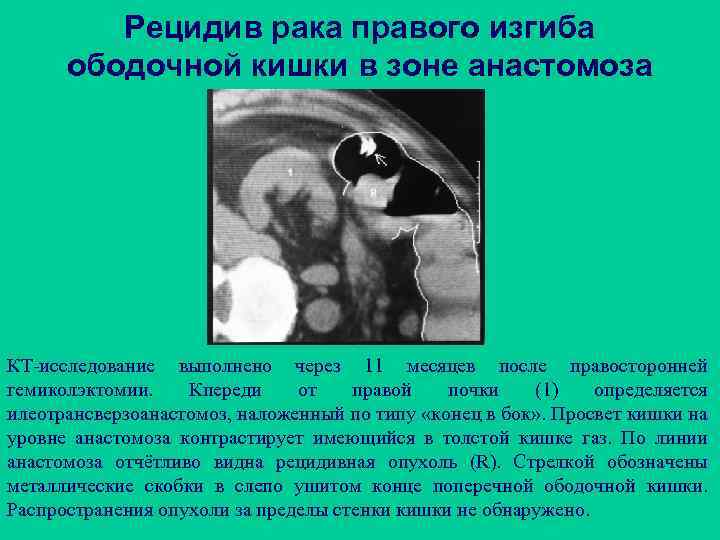 Рецидив рака правого изгиба ободочной кишки в зоне анастомоза КТ-исследование выполнено через 11 месяцев