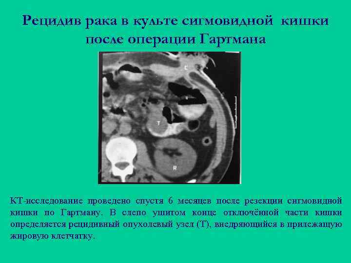 Рецидив рака в культе сигмовидной кишки после операции Гартмана КТ-исследование проведено спустя 6 месяцев