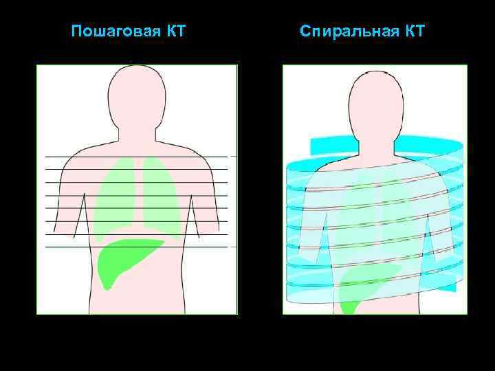 Пошаговая КТ Спиральная КТ 