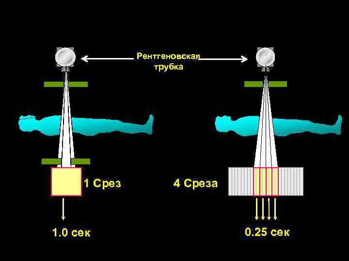 Рентгеновская трубка 1 Срез 1. 0 сек 4 Среза 0. 25 сек 