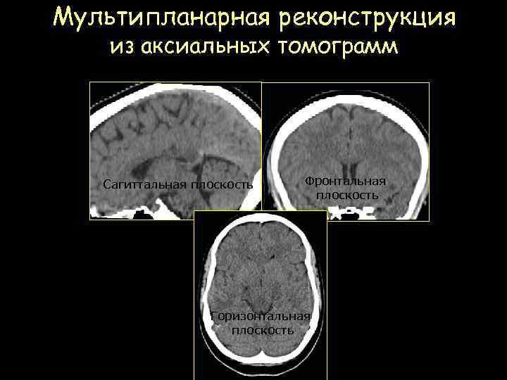 Мультипланарная реконструкция из аксиальных томограмм Головной мозг Сагиттальная плоскость Фронтальная плоскость Горизонтальная плоскость 
