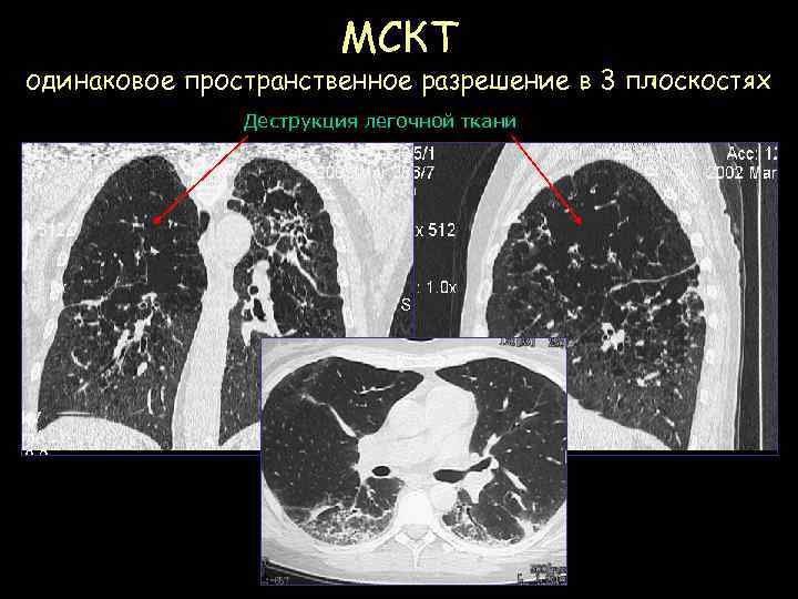 МСКТ одинаковое пространственное разрешение в 3 плоскостях Деструкция легочной ткани 