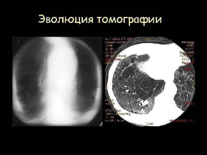 Эволюция томографии Рентгеновская продольная томография легких Компьютерная томография легких 