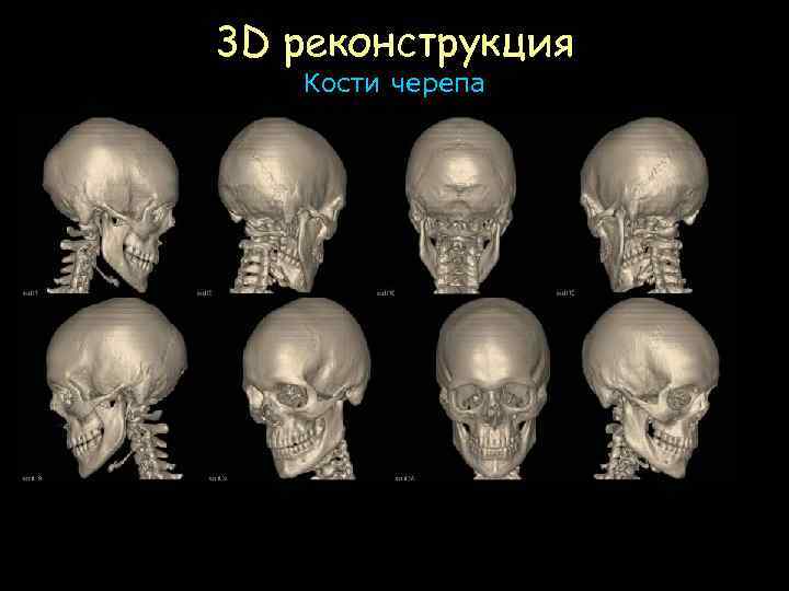3 D реконструкция Кости черепа 