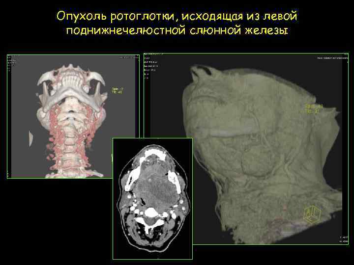 Опухоль ротоглотки, исходящая из левой поднижнечелюстной слюнной железы 