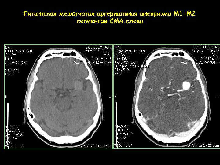 Гигантская мешотчатая артериальная аневризма М 1 -М 2 сегментов СМА слева 