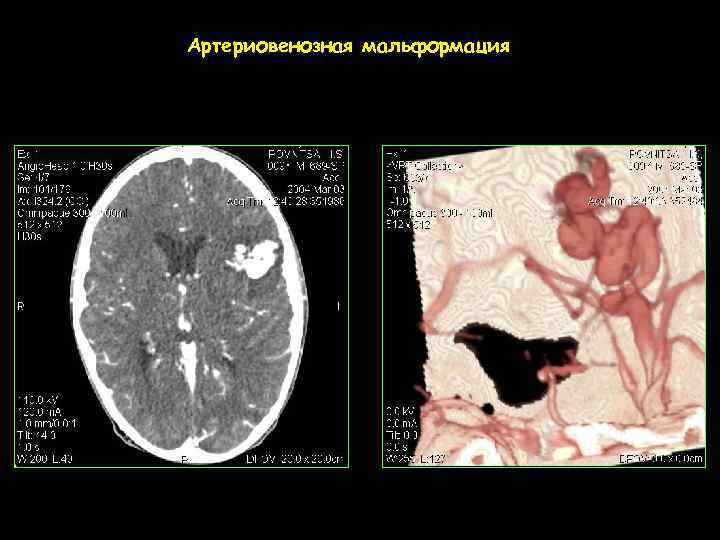 Артериовенозная мальформация 