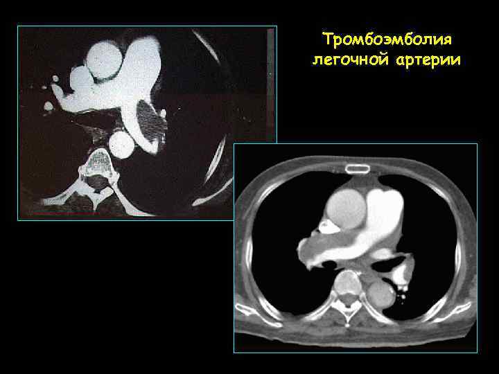 Тромбоэмболия легочной артерии 
