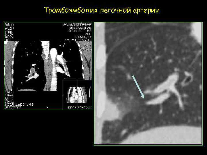 Тромбоэмболия легочной артерии 