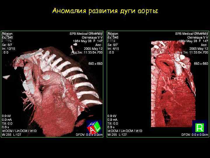 Аномалия развития дуги аорты 