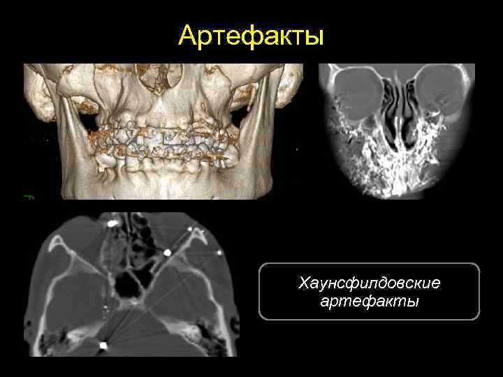 Артефакты Хаунсфилдовские артефакты 5 