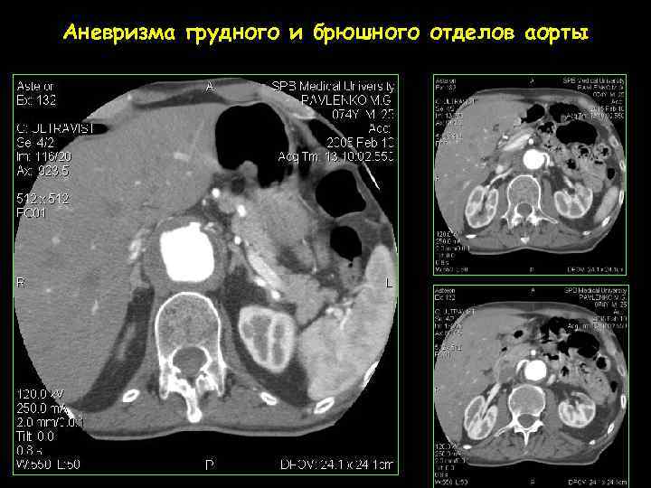 Аневризма грудного и брюшного отделов аорты 