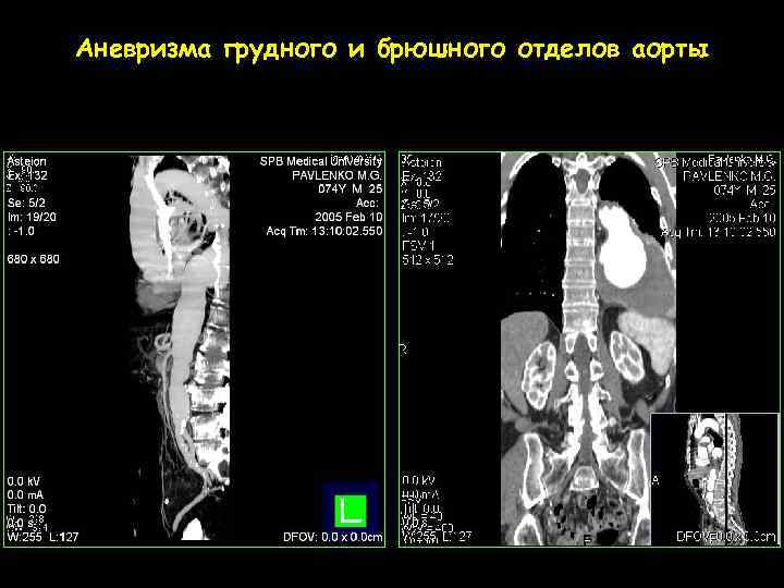 Аневризма грудного и брюшного отделов аорты 