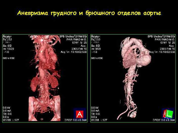 Аневризма грудного и брюшного отделов аорты 