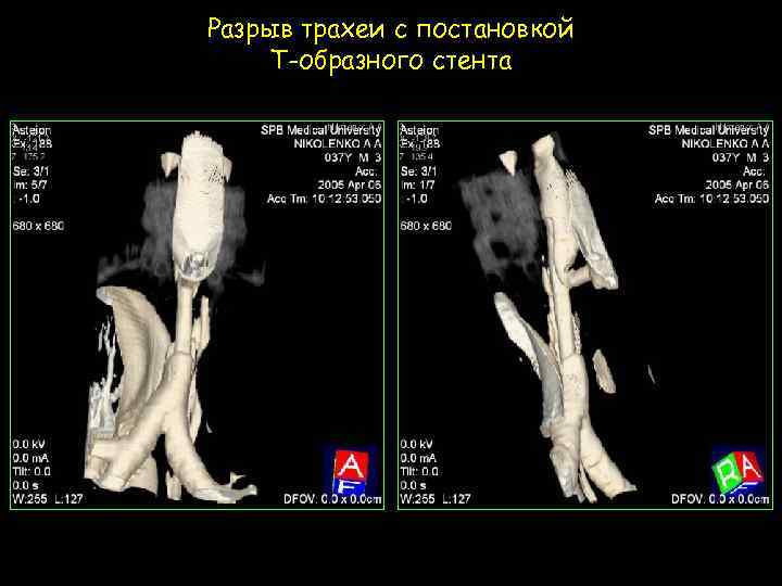 Разрыв трахеи с постановкой Т-образного стента 