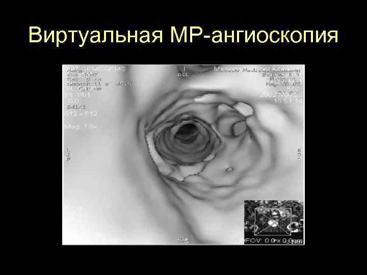 Виртуальная МР-ангиоскопия Нажмите на изображение для запуска видео 