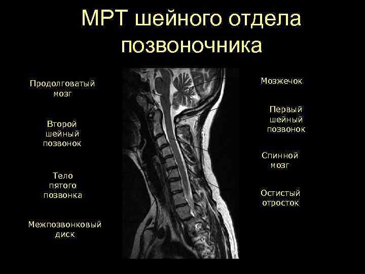 МРТ шейного отдела позвоночника Продолговатый мозг Второй шейный позвонок Мозжечок Первый шейный позвонок Спинной