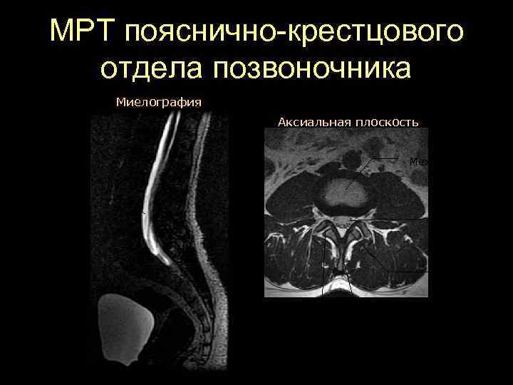 МРТ пояснично-крестцового отдела позвоночника Миелография Аксиальная плоскость Межпозвонковый диск Позвоночный канал Конский хвост Фасеточный