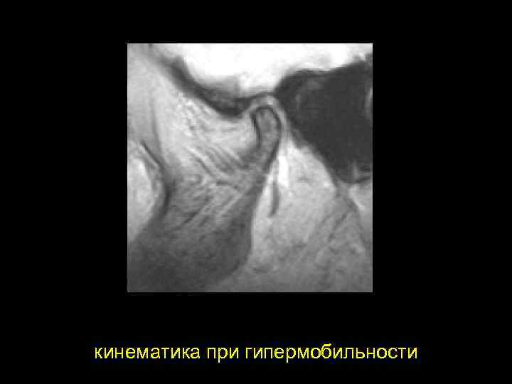 J M T кинематика при гипермобильности 
