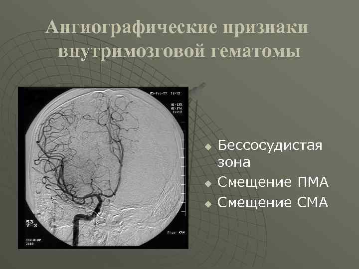 Ангиографические признаки внутримозговой гематомы u u u Бессосудистая зона Смещение ПМА Смещение СМА 