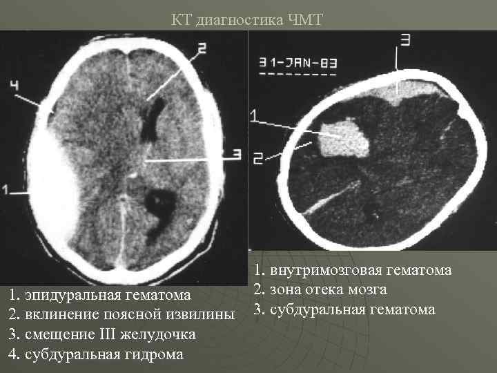 КТ диагностика ЧМТ 1. эпидуральная гематома 2. вклинение поясной извилины 3. смещение III желудочка