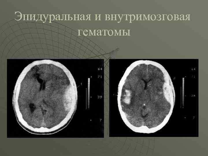 Эпидуральная и внутримозговая гематомы 