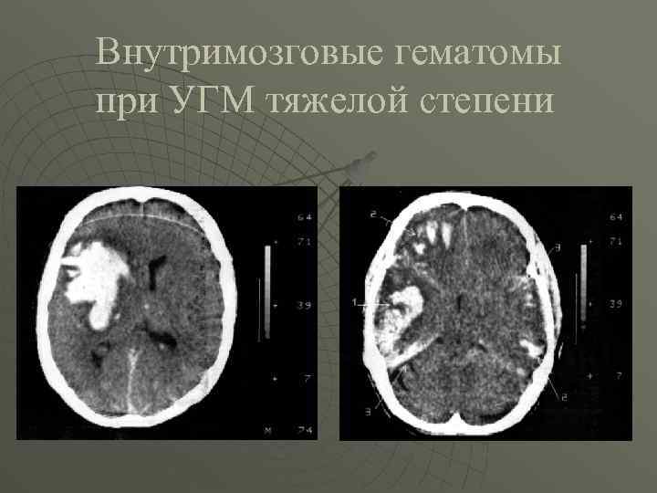 Внутримозговые гематомы при УГМ тяжелой степени 