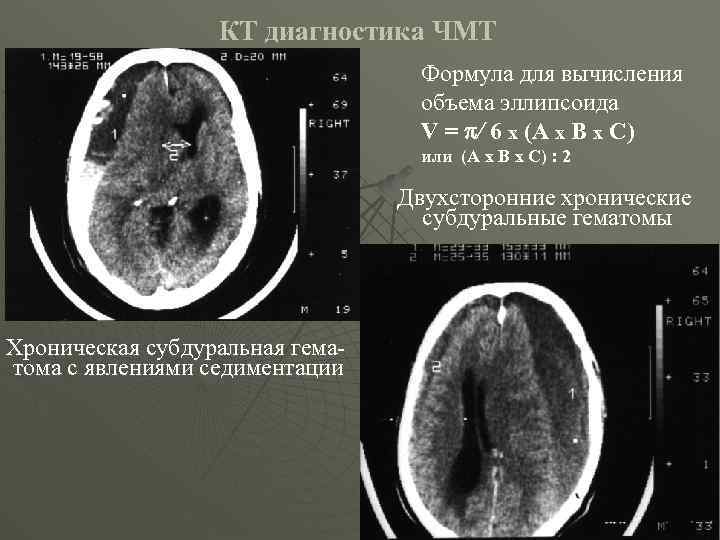 КТ диагностика ЧМТ Формула для вычисления объема эллипсоида V = / 6 x (A