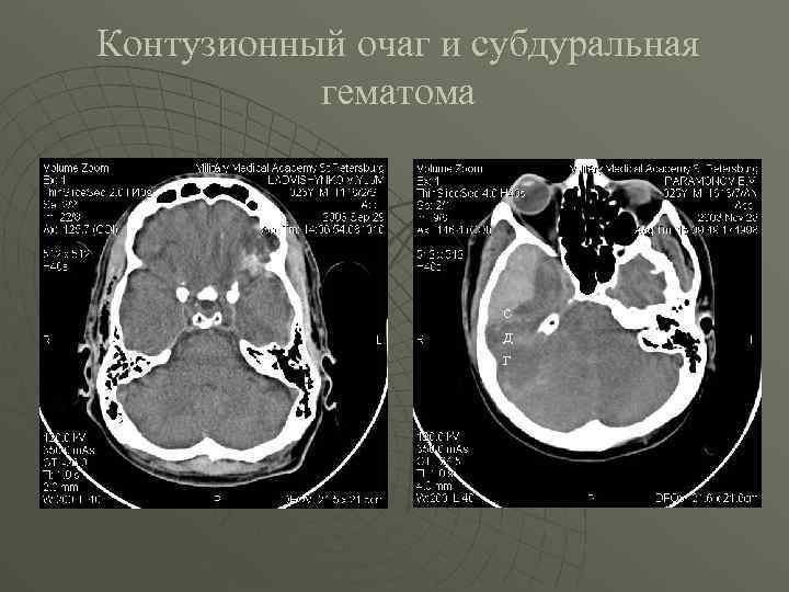 Контузионный очаг и субдуральная гематома с д г 