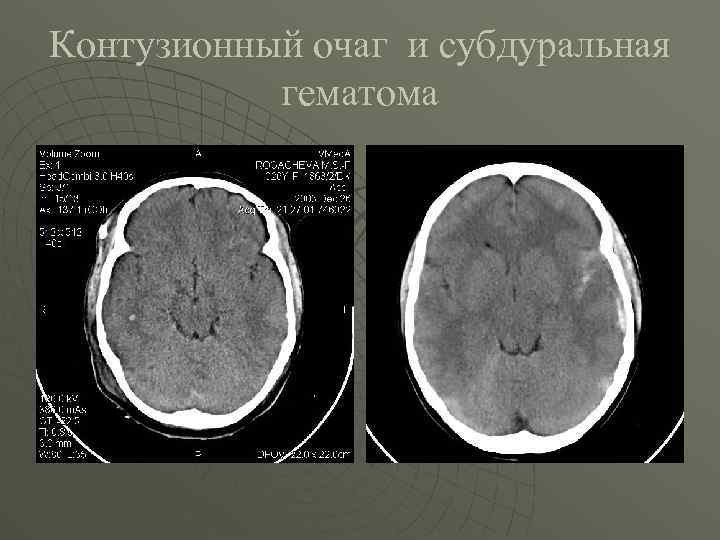 Контузионный очаг и субдуральная гематома 