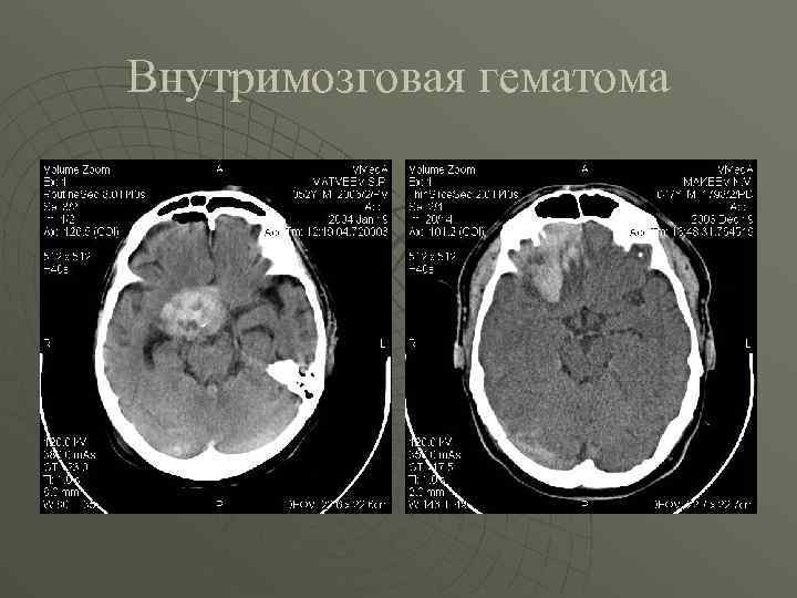 Внутримозговая гематома 