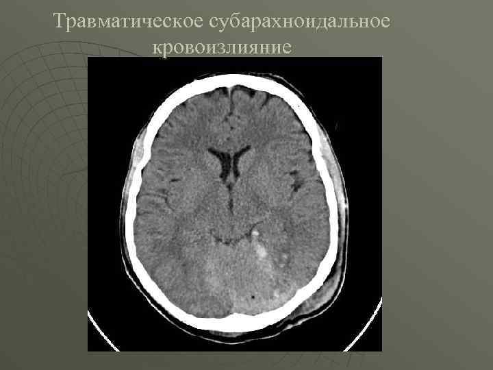 Травматическое субарахноидальное кровоизлияние 