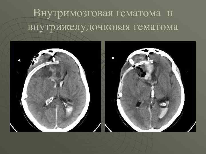 Внутримозговая гематома и внутрижелудочковая гематома 