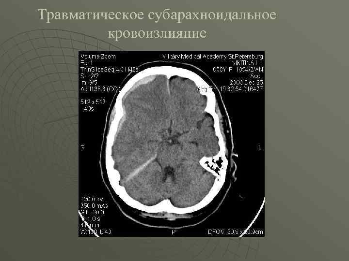 Травматическое субарахноидальное кровоизлияние 