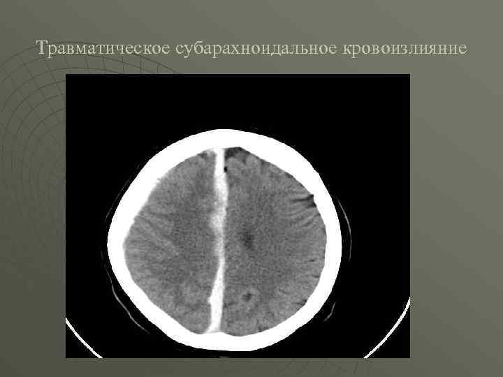 Травматическое субарахноидальное кровоизлияние 