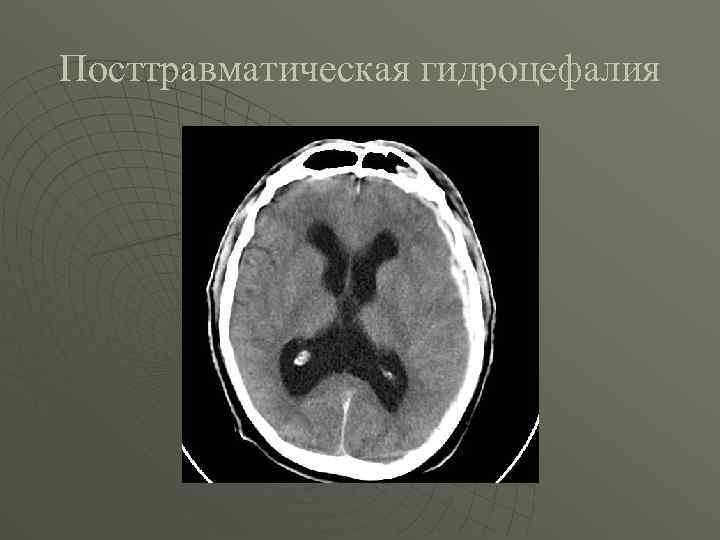 Посттравматическая гидроцефалия 