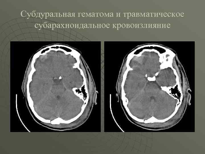 Субдуральная гематома и травматическое субарахноидальное кровоизлияние 