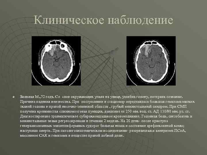 Клиническое наблюдение u Больная М. , 72 года. Со слов окружающих упала на улице,