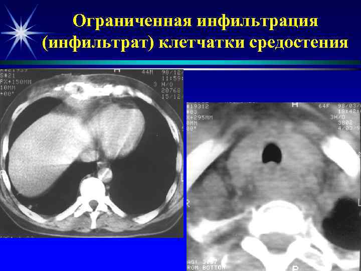 Ограниченная инфильтрация (инфильтрат) клетчатки средостения 