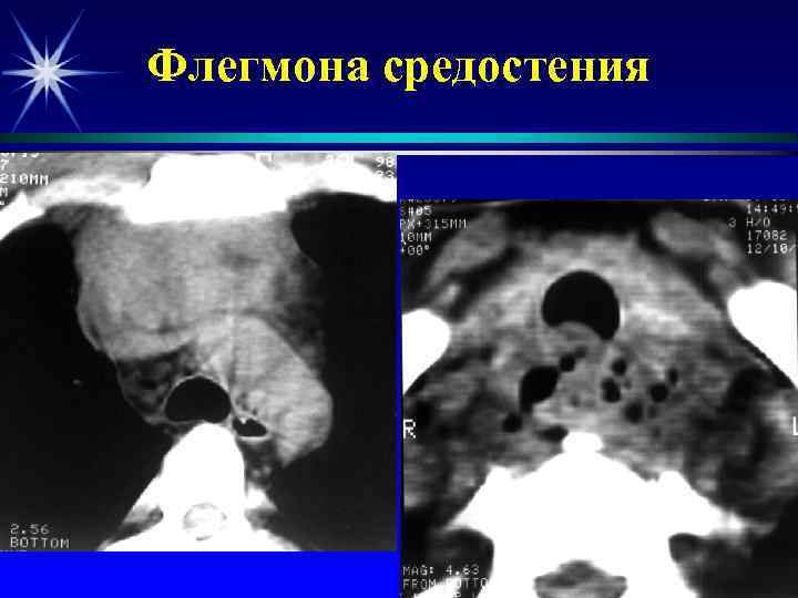 Флегмона средостения 