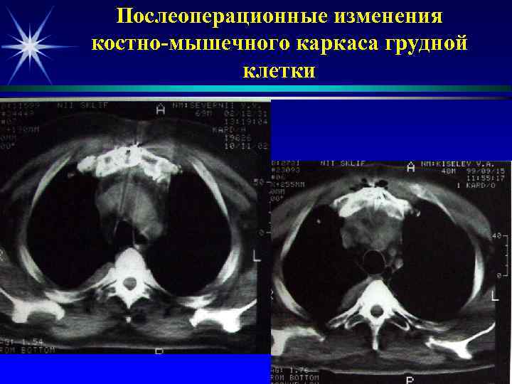 Послеоперационные изменения костно-мышечного каркаса грудной клетки 