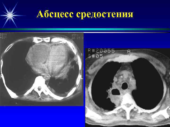 Абсцесс средостения 