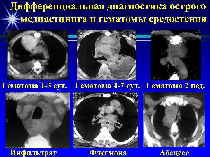 Дифференциальная диагностика острого медиастинита и гематомы средостения Гематома 1 -3 сут. Инфильтрат Гематома 4