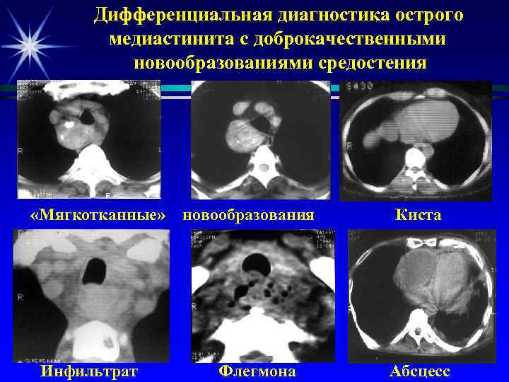 Дифференциальная диагностика острого медиастинита с доброкачественными новообразованиями средостения «Мягкотканные» Инфильтрат новообразования Флегмона Киста Абсцесс