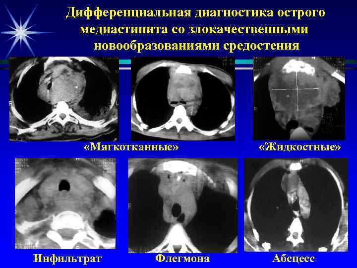 Дифференциальная диагностика острого медиастинита со злокачественными новообразованиями средостения «Мягкотканные» Инфильтрат Флегмона «Жидкостные» Абсцесс 