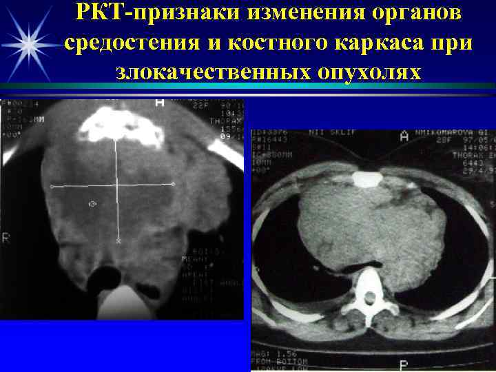 РКТ-признаки изменения органов средостения и костного каркаса при злокачественных опухолях 