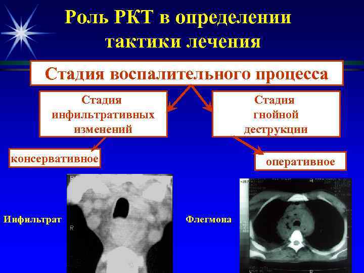 Роль РКТ в определении тактики лечения Стадия воспалительного процесса Стадия инфильтративных изменений Стадия гнойной